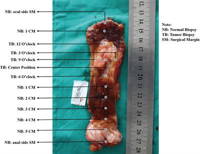 Evaluation of the Impact of Intratumoral Heterogeneity of Esophageal Cancer on Pathological Diagnosis and P16 Methylation and the Representativity of Endoscopic Biopsy